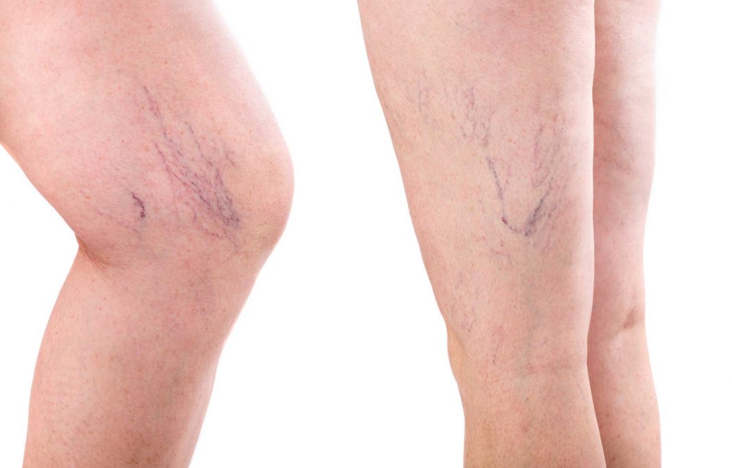 spider veins treatment