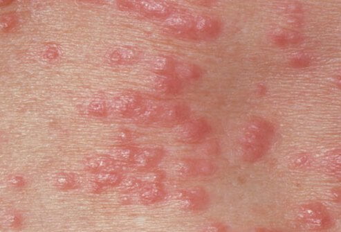 Best top ten home remedy treatments for scabies Natural cures for scabies