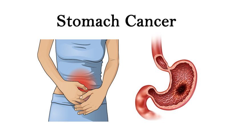 stomach cancer symptoms