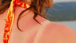 sunburn cures