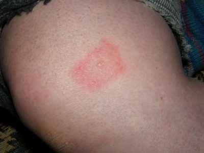 Tick bites