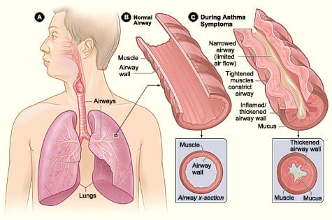 symptoms of asthma