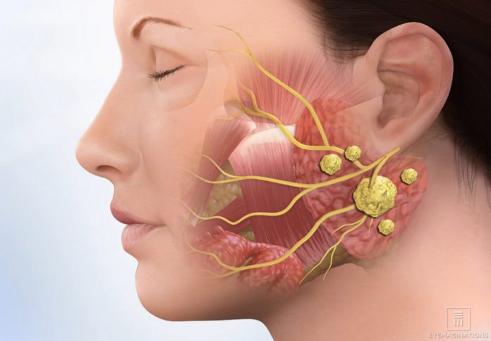 Natural cure for salivary duct stones