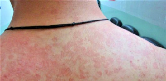 tinea versicolor treatment