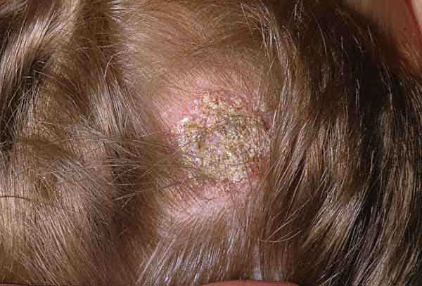 Scalp Ringworm Symptoms And Causes