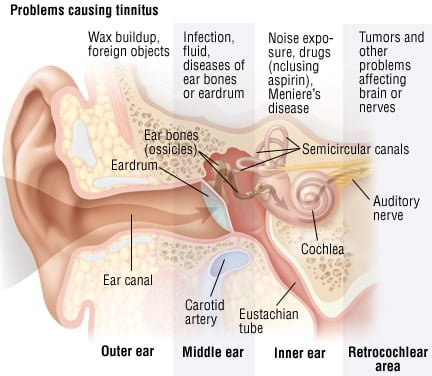 tinnitus causes