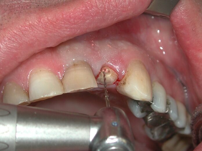 tooth extraction healing pictures