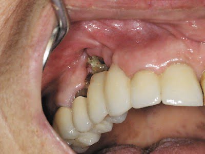 Natural cures for tooth abscess