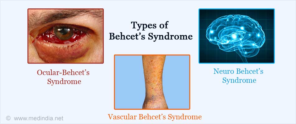 types of behcets syndrome