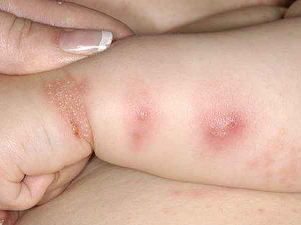 west nile virus symptoms