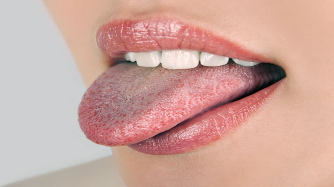 18 Best natural treatments for White Tongue