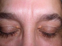 xanthelasma treatment and cure