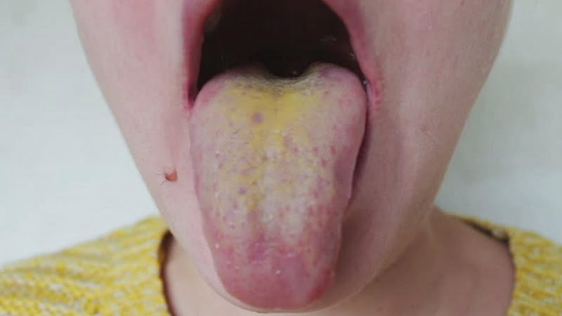 yellow tongue treatment